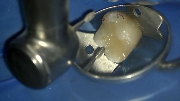 Laserowo wspomagane pokrycie bezpośrednie miazgi – opis przypadku