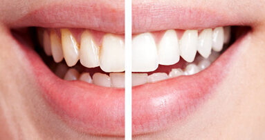 L'Union européenne applique des règles plus strictes pour la vente et l'utilisation de produits de blanchiment des dents