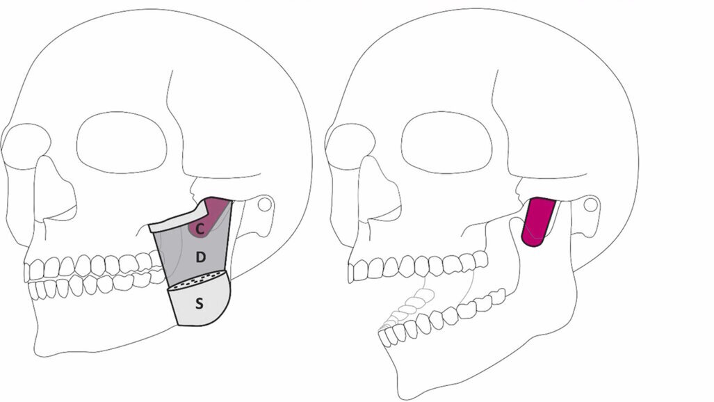 İnsan Çenesinde Yeni Bir Kas Katmanı Keşfedildi