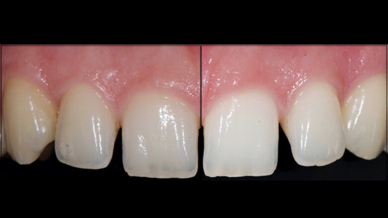 Dokonalost a komfort při bělení