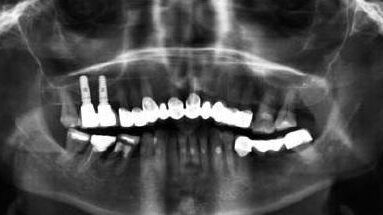 Augmentacja dna zatoki szczękowej bez użycia wytwarzanych komercyjnie biomateriałów