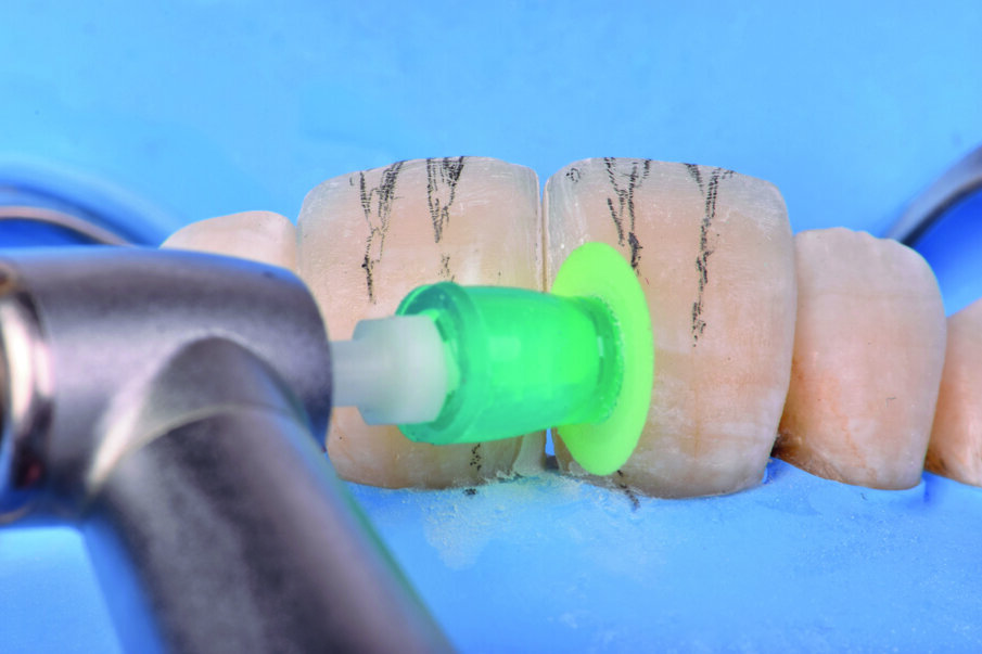 Fig 19. Polishing of the restorative surface with Super-Snap X-Treme Green and Red Disks