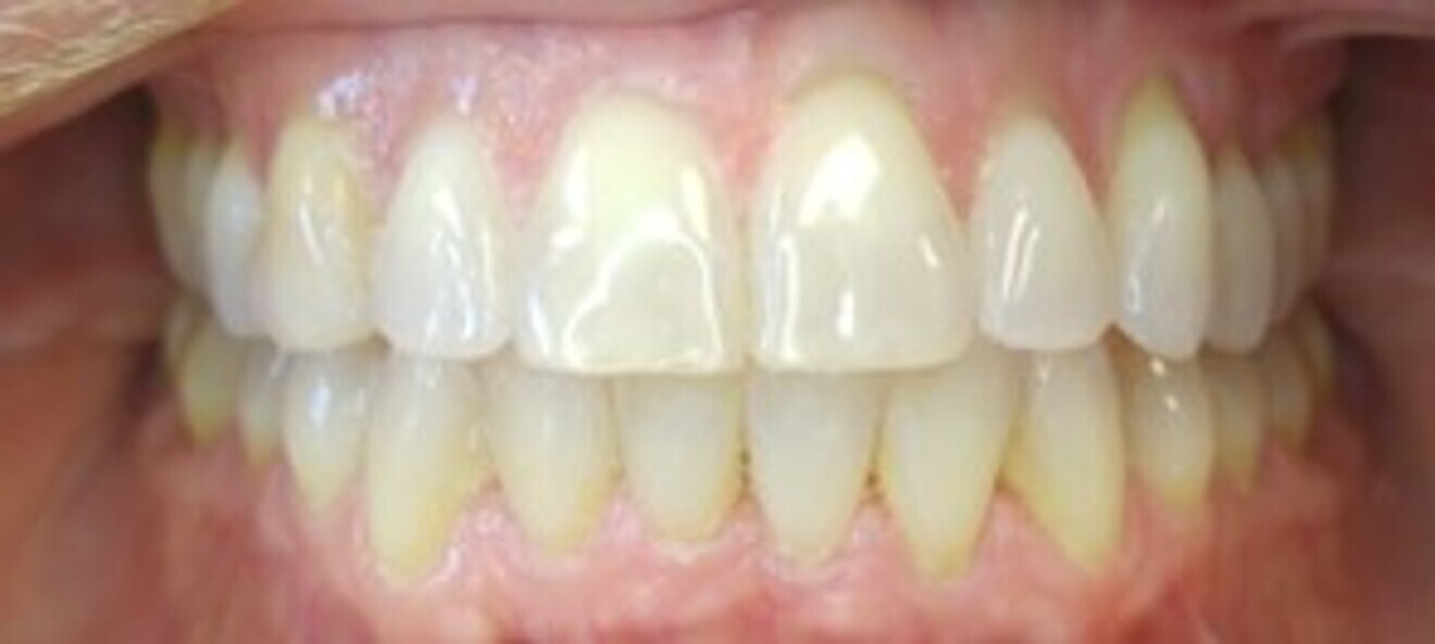 Fig. 8: Movement achieved after 11 months without attachments.