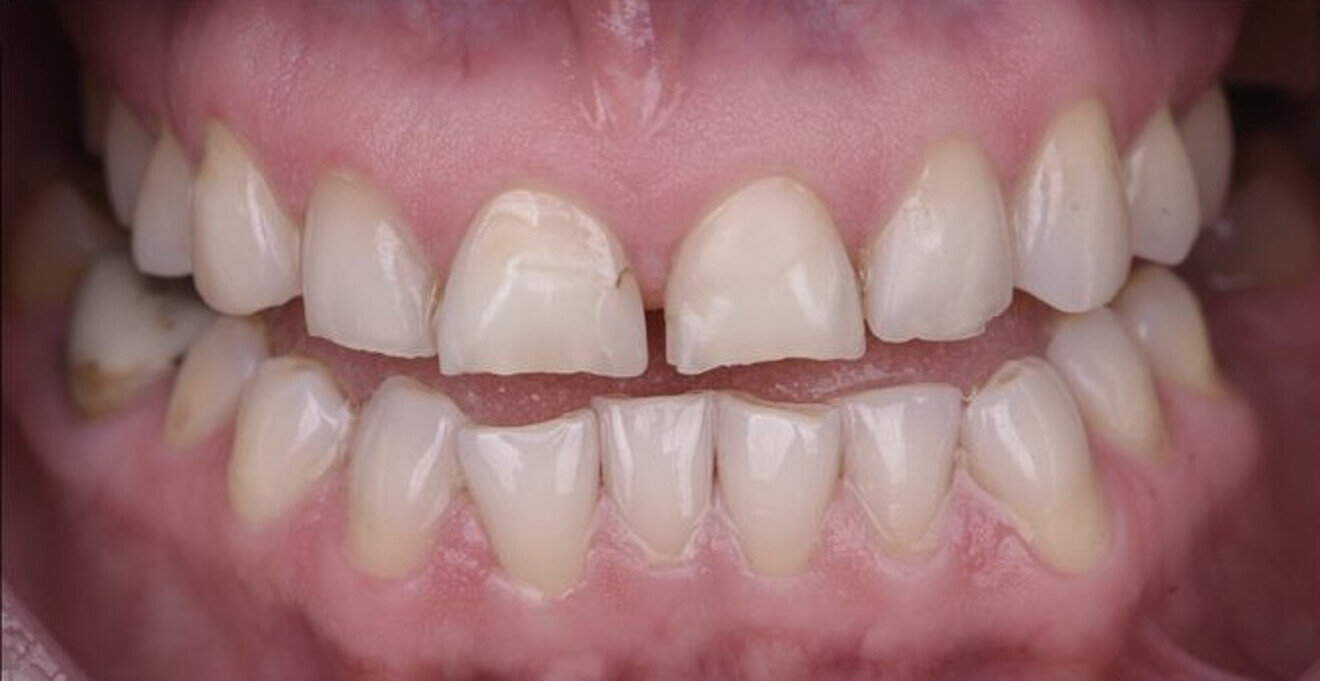 Fig. 1b: Intra-oral view with the teeth separated.