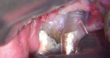 La tecnologia laser VSP nella gestione delle perimplantiti