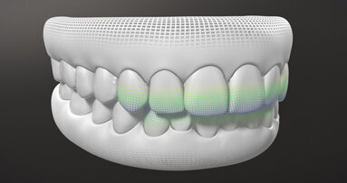 Invisalign G8, systém s novými aktivačními funkcemi SmartForce Aligner Activation