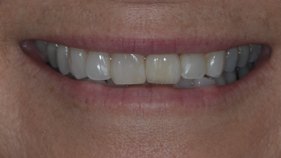 Fig. 31_Risultato finale del sorriso.