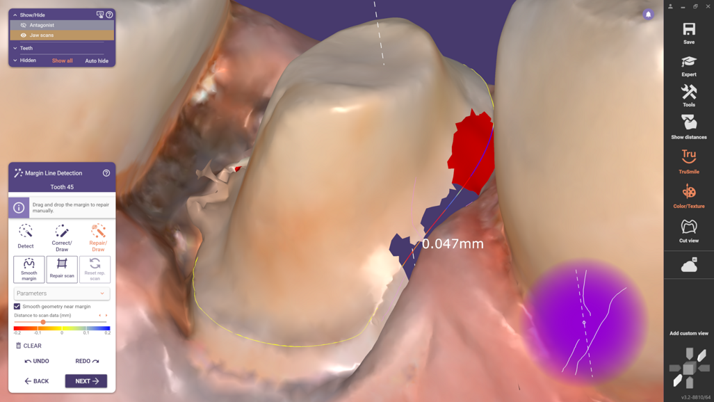 DentalCAD 3.2 enhances precision with new tool for repairing preparation margins