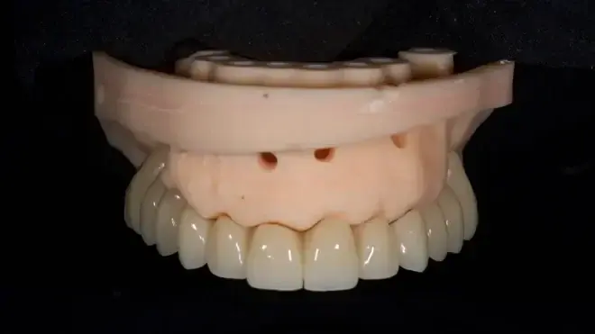 Фиг. 5: Предварително изработена временна протеза от PMMA. 