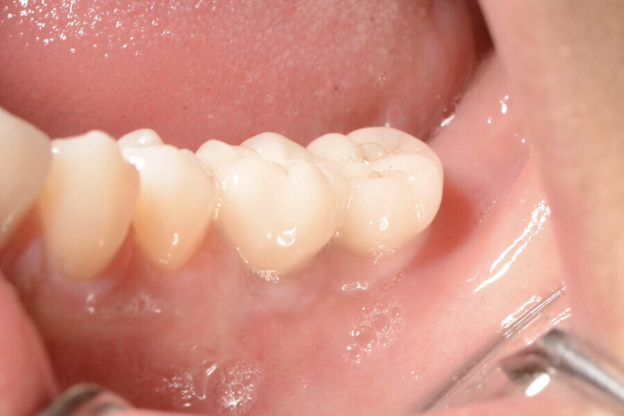 Fig. 18 : Aspect clinique de la zone des tissus mous péri-implantaires lors du suivi à deux ans. 