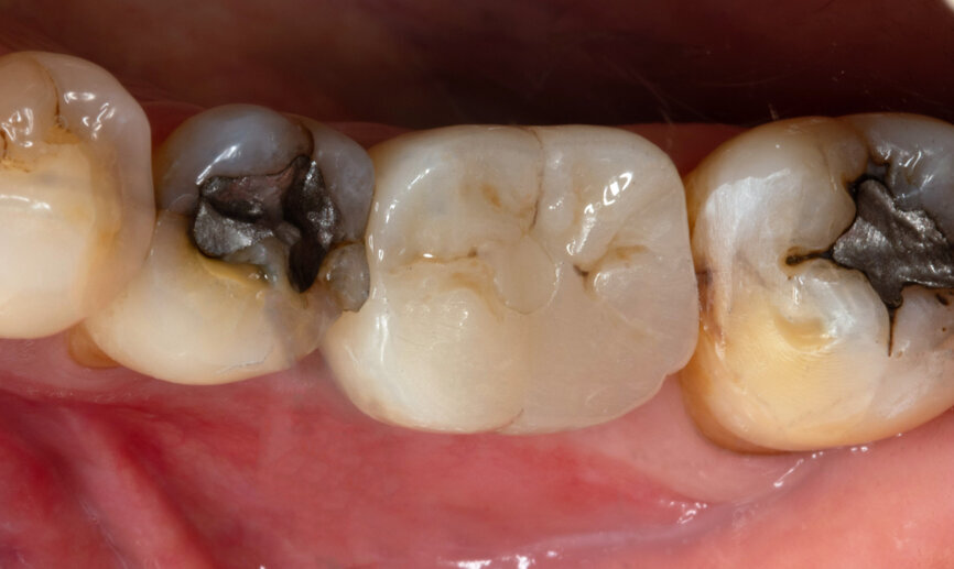 Fig. 25: Final result—occlusal view.