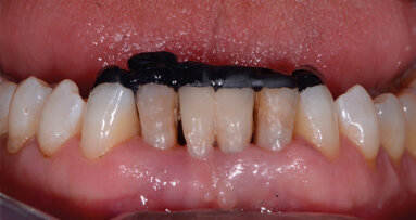 Composito nero: un nuovo ausilio nello Smile Design