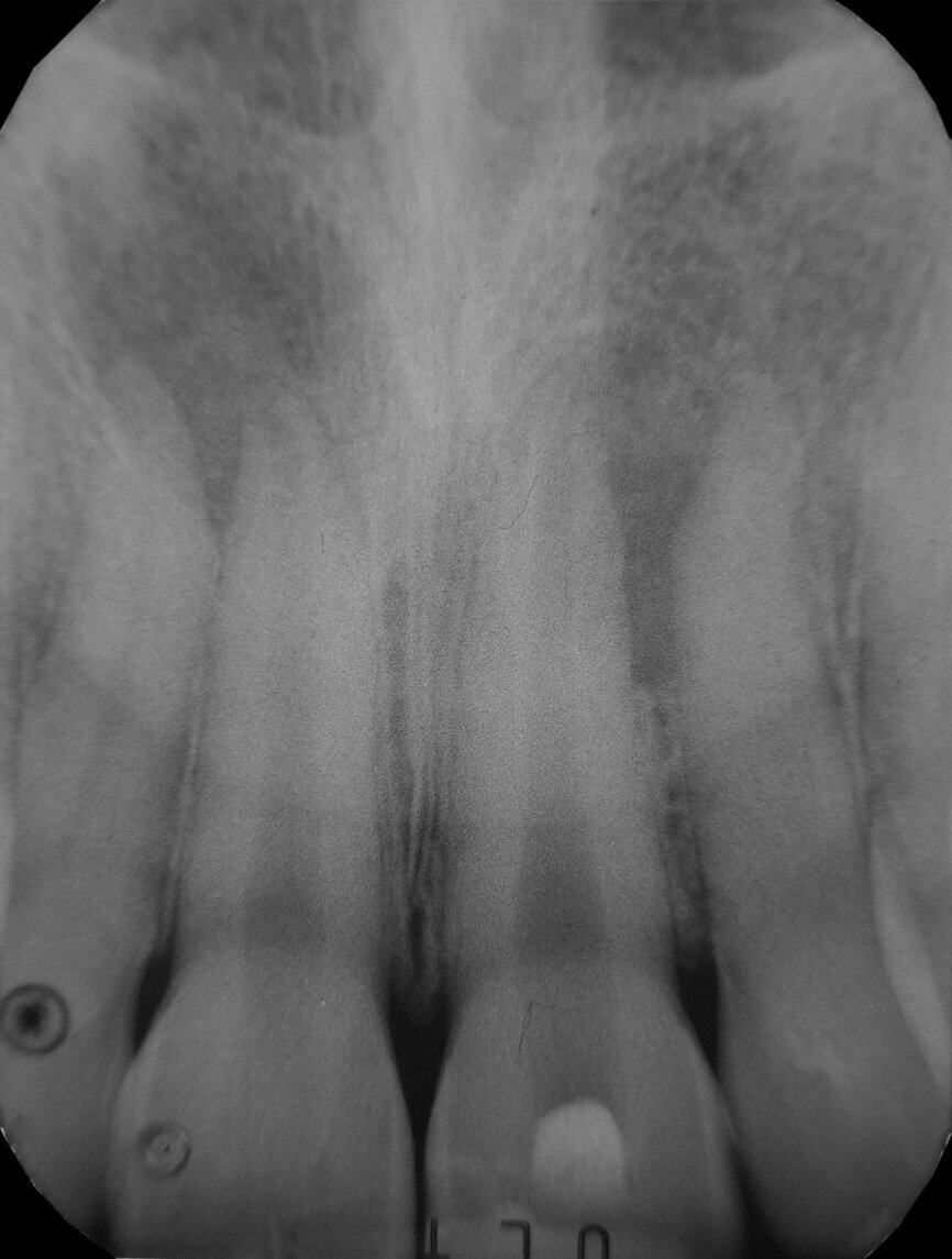 Fig. 1: Pre-operative radiograph