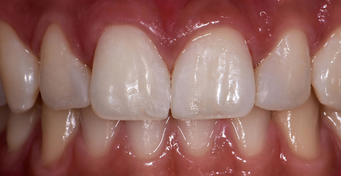 Fig. 16: Completed restoration.