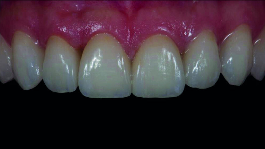 Fig. 15b: CAD/CAM veneers with try-in paste.