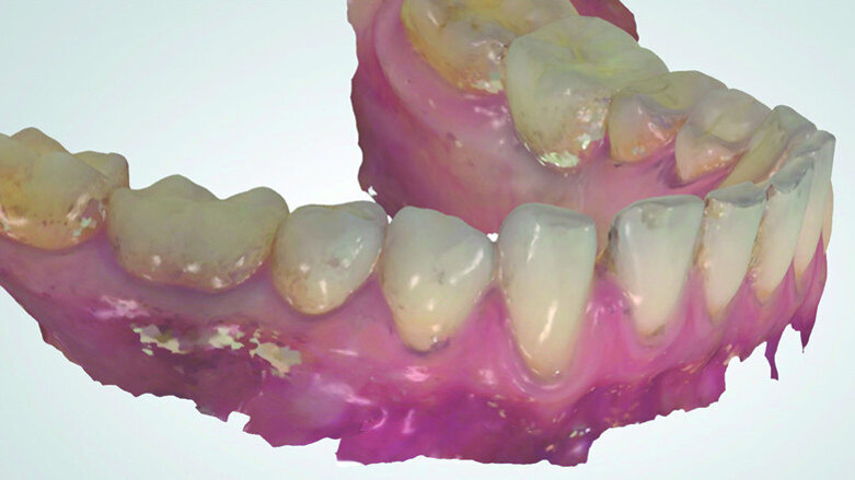 Optical impression and provisional prosthesis: Proposal for a new approach