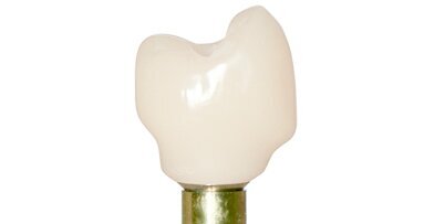 Corona implantosoportada de cerámica híbrida CAD/CAM