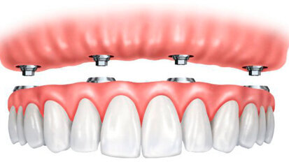 Il mercato dell Overdenture in Francia è tra i più redditizi d’Europa