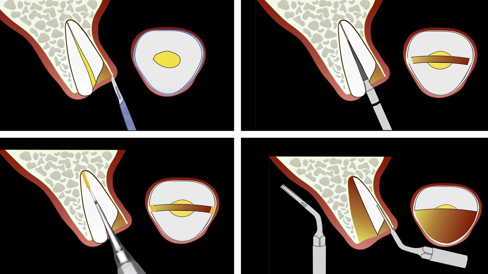 Piezocirugía  (8). La llegada de la exodoncia atraumática