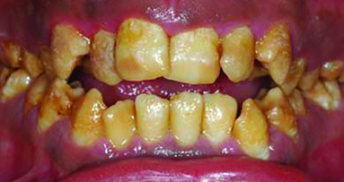 Cosmetic enamel restoration using naturomimetic layering technique—Part I