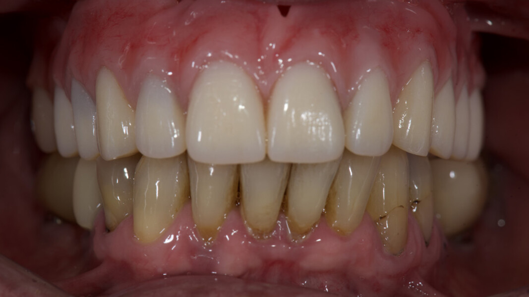Fig. 23_Posizionamento e funzionalizzazione della protesi nel cavo orale, con fissazione degli attacchi implantari e cuffie di ritenzione.