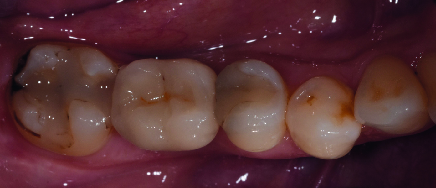 Fig. 27 : Intégration de la couronne d’usage, en vue occlusale.
