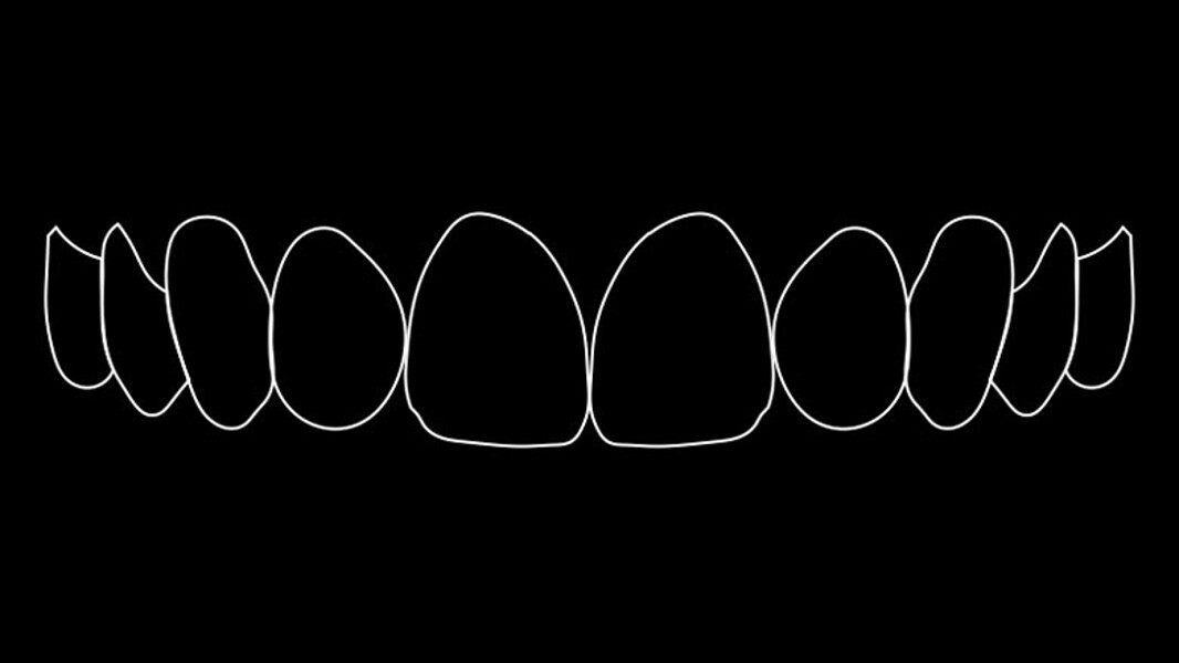 Figura 3. Simulación numérica de la sonrisa ideal.