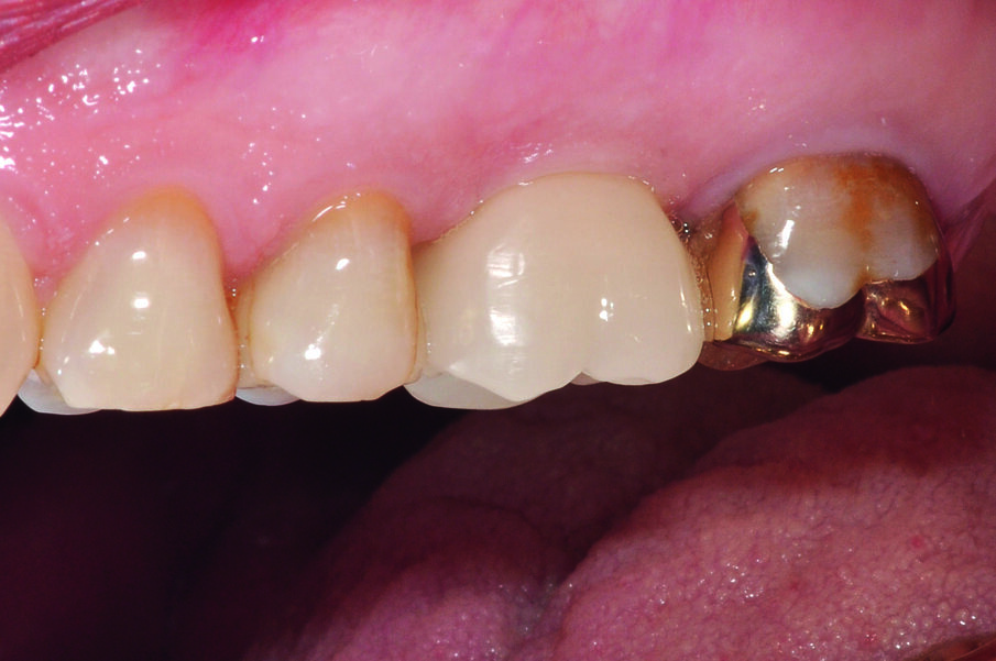 Fig. 16: Result: A check-up after a few weeks showed excellent soft tissue conditions.