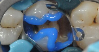 Behandeling van een falende restauratie 26 met behulp van SDR en Ceram-X Universal