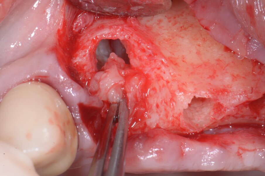 Fig. 6 - Posizionamento membrane di PRF nei siti osteotomici.