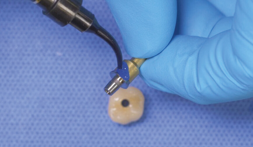 Fig. 1: After attaching the titanium abutment to the implant analogue, protect the base of the abutment by applying block-out resin. 