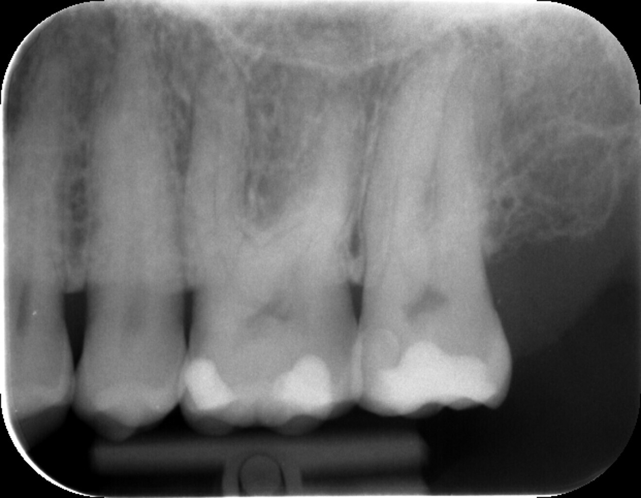 Fig. 1: Pre-op radiograph of tooth #27.