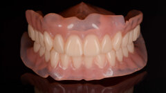 CAD/CAM complete dentures fabricated using additive and subtractive procedures