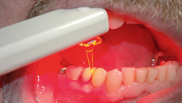 LED als alternative Behandlungsmethode zum Laser?