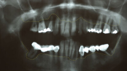Riabilitazione bimascellare su impianti in paziente con iperplasia mascellare: step-to-step