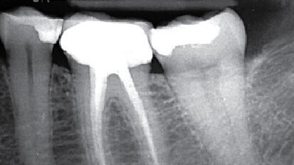 Prípad diagnostikovania až po sprístupnenie