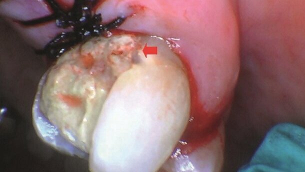 Ablacja twardych i miękkich tkanek jamy ustnej za pomocą lasera Solea CO2 o długości fali 9,3 µm