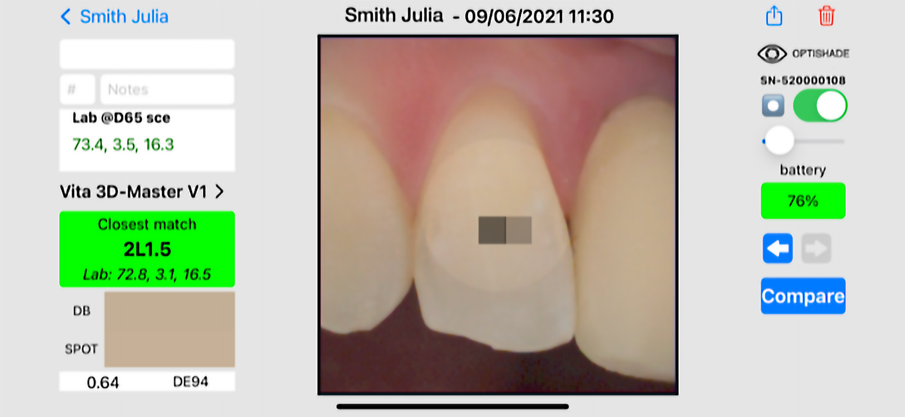 Fig. 16: Measurement of the shade of the maxillary lateral incisor.