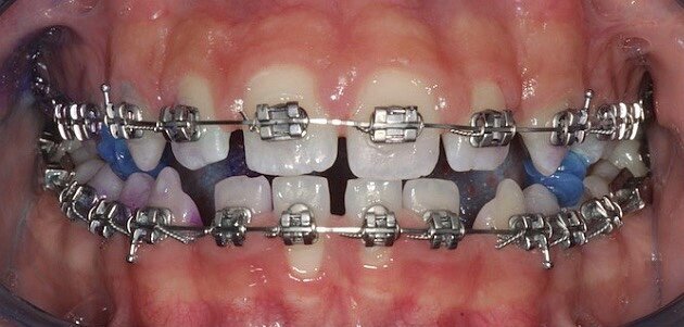 Fig. 1 - Case report di ortodonzia tradizionale. Fotografia frontale a t0 con rilevatore di placca.