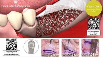 Complexe botdefecten, weefseltoename en spanningsvrij hechten