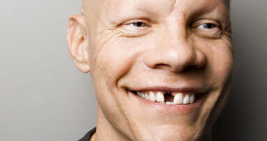 Brza i jednostavna kompozitna restauracija