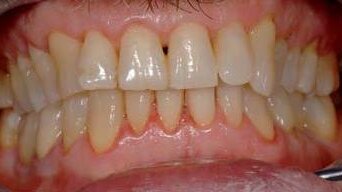 Zmiany w szkliwie – metody odbudowy