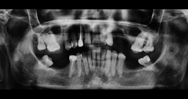 Tecniche e materiali nella riabilitazione implanto supportata per mezzo di Sinus Lift e GBR