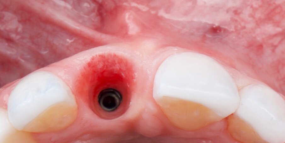 Fig. 22: Intra-oral view three months after the procedure showing the emergence profile.