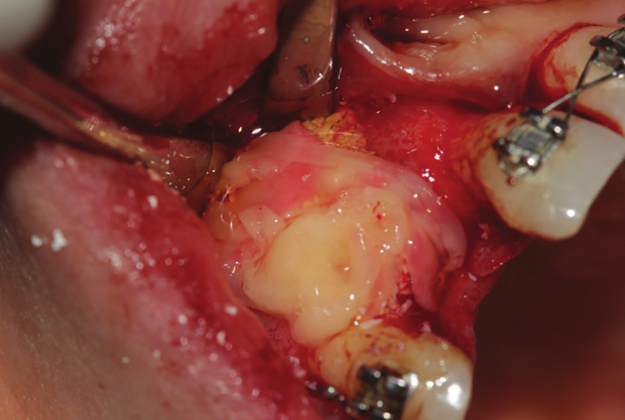 Figure 27: First layer of L-PRF covering the bovine bone associated PRF complex (sticky bone).