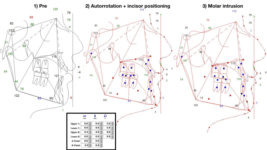 Figs. 6a–c: Visual treatment objectives. Pretreatment situation (a). Situation after auto-rotation and incisor positioning (b). Situation after molar intrusion (c).