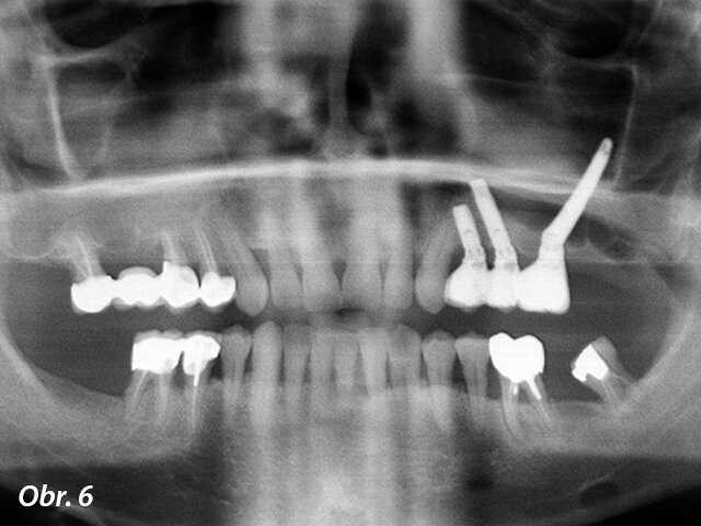 Kontrolní RTG: léčba byla v tomto případě dokončena v 5 měsících.
