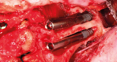 Il trattamento delle gravi atrofie mediante impianti zigomatici: una pratica per l’odontoiatra?