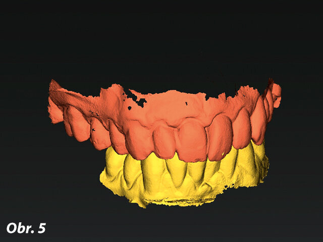Obr. 5: STL soubor z digitálního otiskování