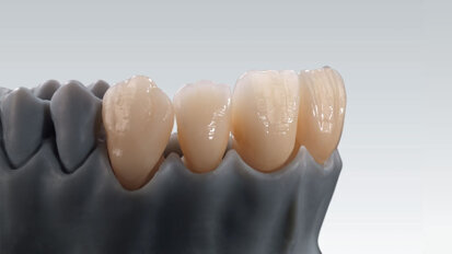 Zolid Gen-X – The new universal zirconium that changes everything